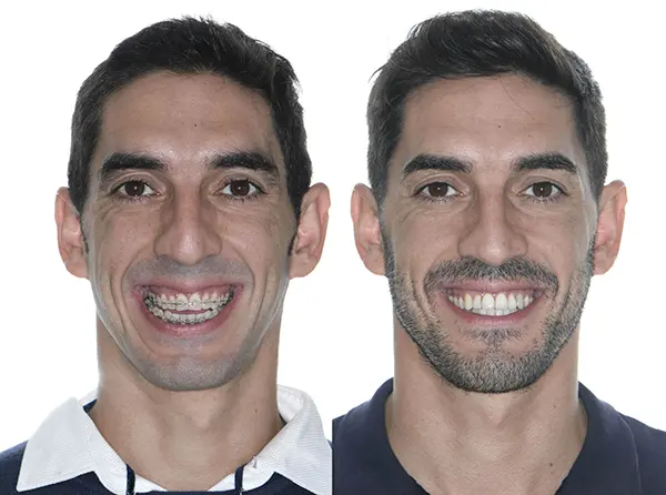 Antes y despu&eacute;s de Cirug&iacute;a Ortogn&aacute;tica